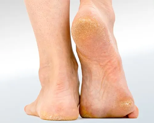قارچ (پای ورزشکار): پوسته‌ریزی و خارش