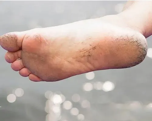خشکی و پوسته‌ریزی منتشر کف پا