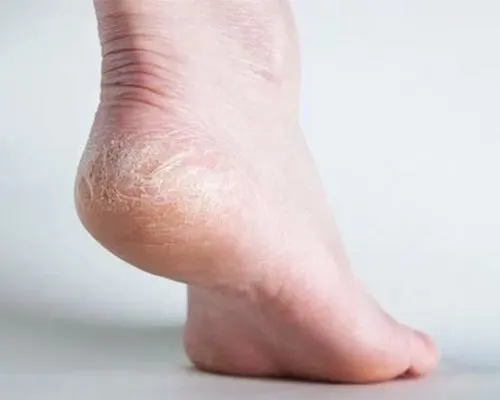 پاشنه: ترک و پوسته‌ریزی ناشی از خشکی